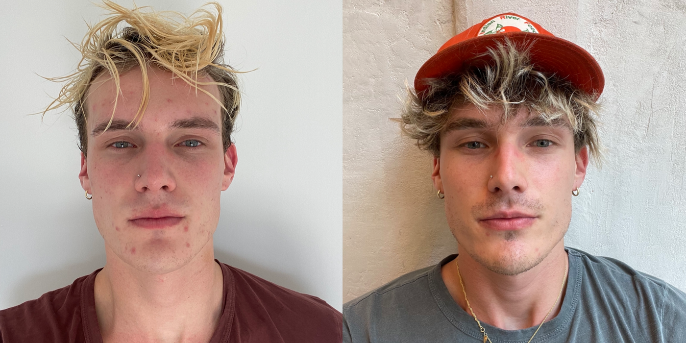 SKIN TRANSFORMATION: Checking in with Christian