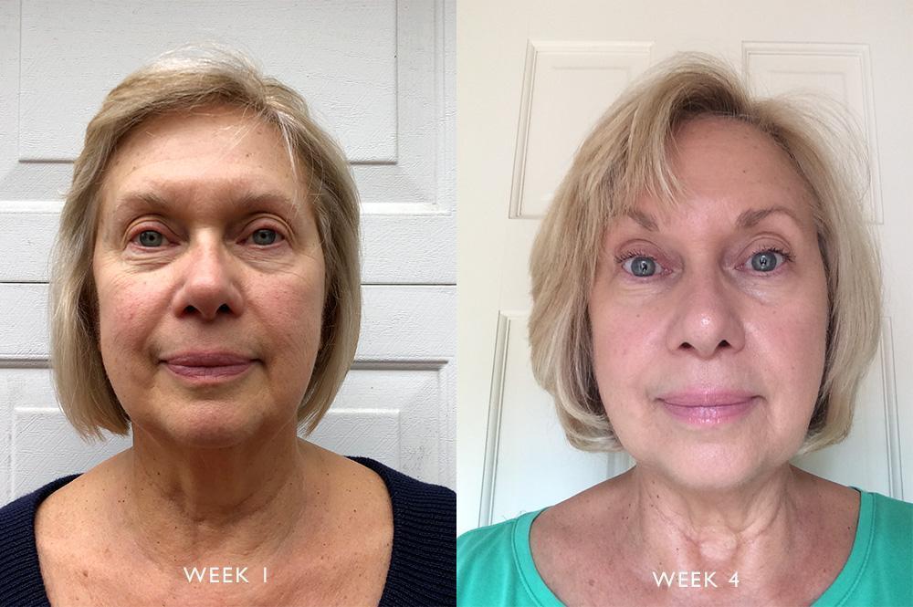 Skin Transformation: Nancy's Routine For Elasticity and Rosacea